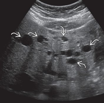 Hepatic Cyst 초음파 이미지