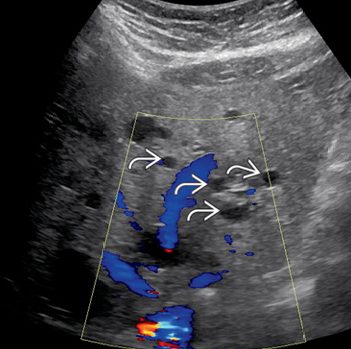Hepatic Cyst 초음파 이미지