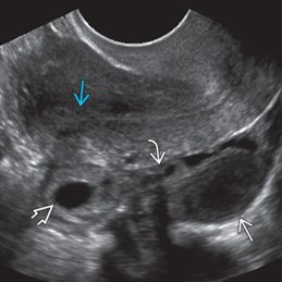 Tubal Ectopic Pregnancy 초음파 이미지