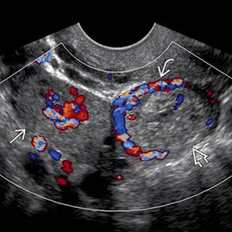 Tubal Ectopic Pregnancy 초음파 이미지