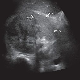 Acute Pyelonephritis 초음파 이미지