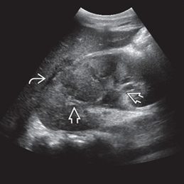 Acute Pyelonephritis 초음파 이미지