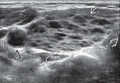 Hashimoto Thyroiditis 초음파 이미지