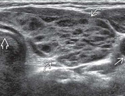 Hashimoto Thyroiditis 초음파 이미지